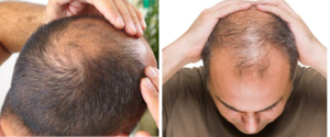 Balding Remedies: How to overcome baldness naturally? Home remedies for hair loss and best medicine for hair fall and regrowth